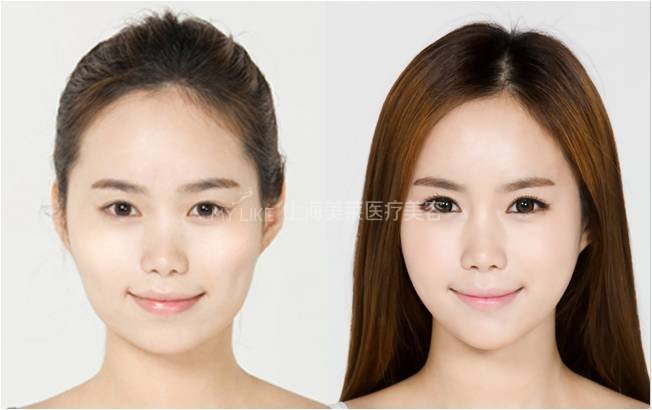 瘦脸前后对比图