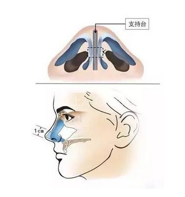 常用的鼻部整形材料,你了解吗?